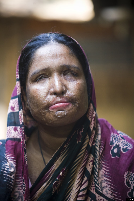 Michael McManus, VSO Youth for Development volunteer, working at Agrogoti Sangstha, an organisation that works to ensure good governance and human rights for all. Pictured: A tearful Nurbanu, acid attack survivor and beneficiary of Agrogoti Sangstha, as s